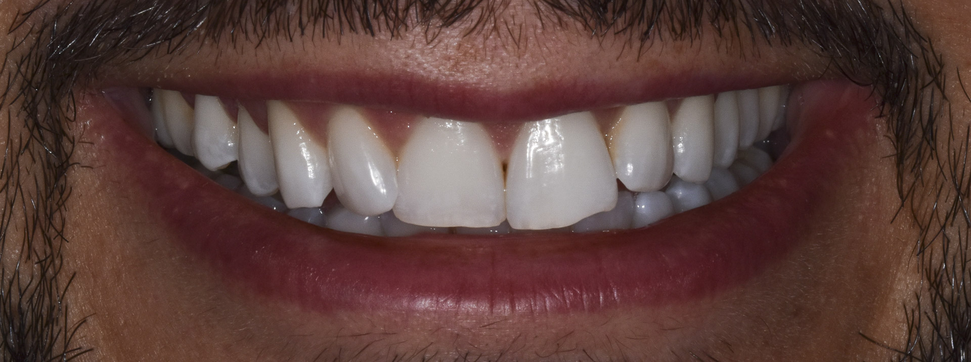 sbiancamento-denti-quarta-odontoiatria-studio-dentistico-carmiano-lecce-c1_1