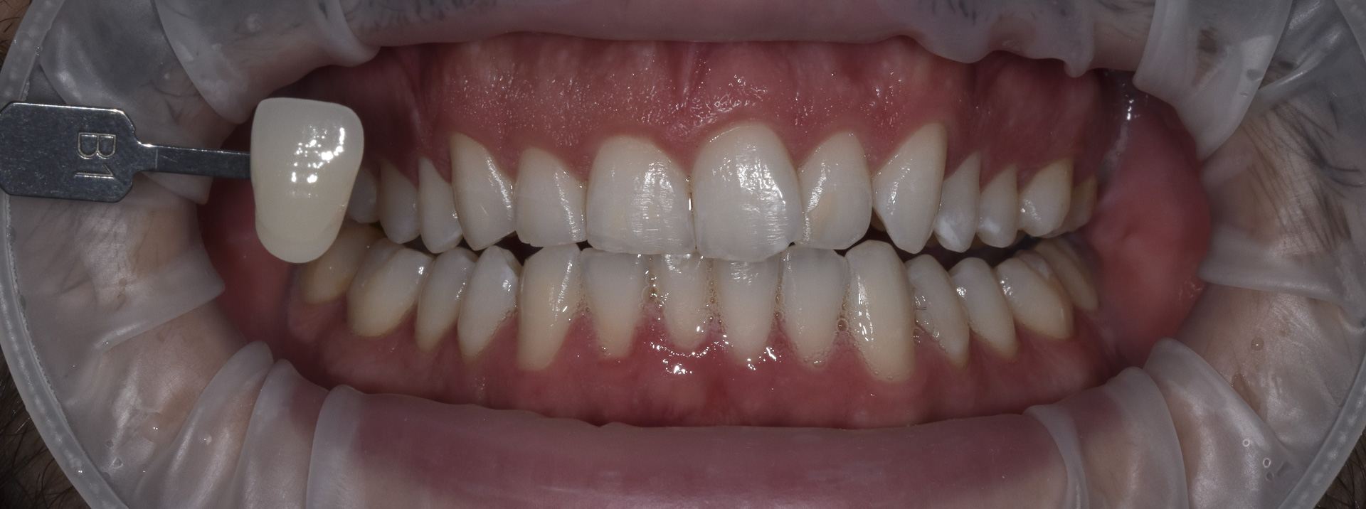 sbiancamento-denti-quarta-odontoiatria-studio-dentistico-carmiano-lecce-c2
