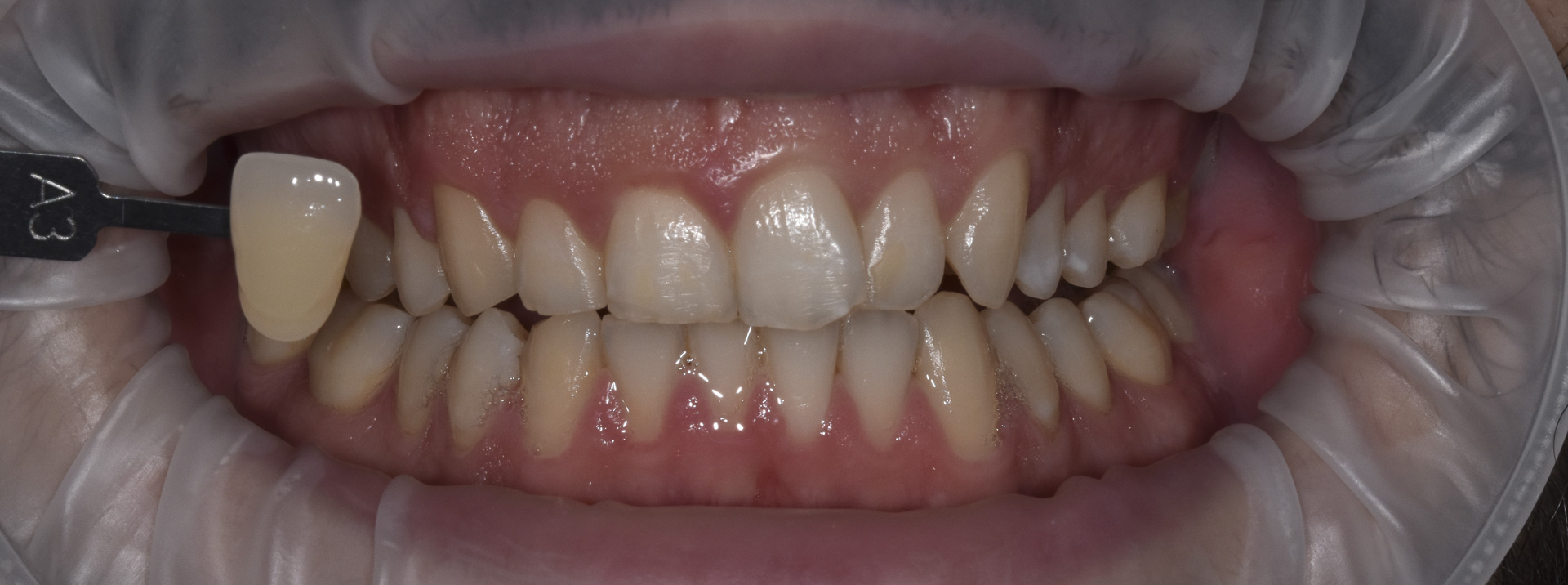 sbiancamento-denti-quarta-odontoiatria-studio-dentistico-carmiano-lecce-c2_2