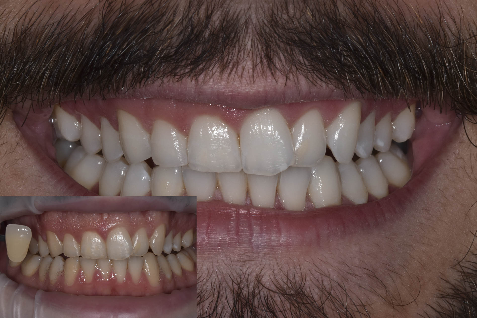 sbiancamento-denti-quarta-odontoiatria-studio-dentistico-carmiano-lecce-c2d