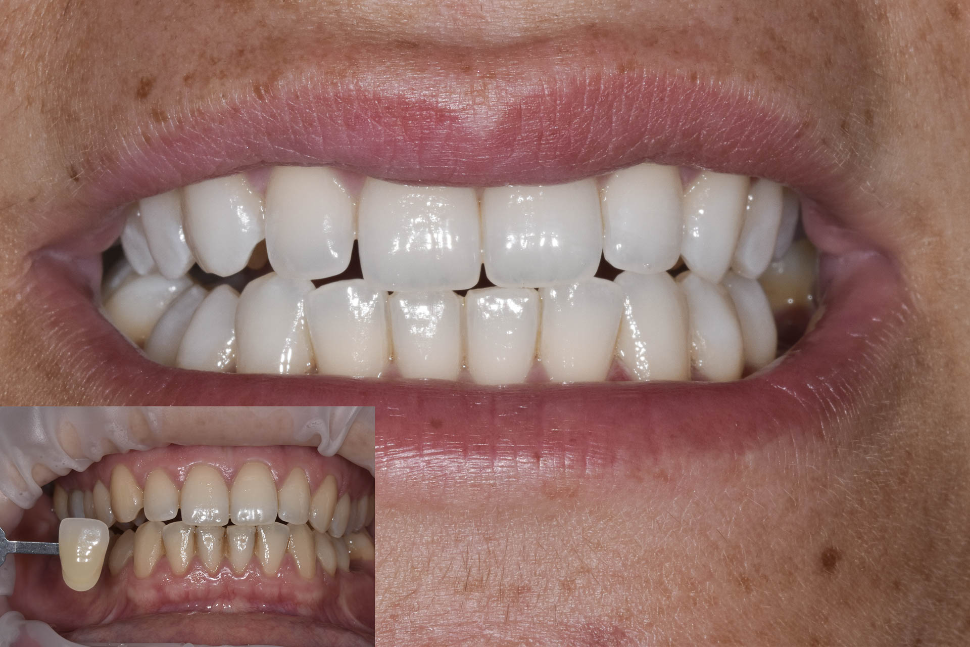 sbiancamento-denti-quarta-odontoiatria-studio-dentistico-carmiano-lecce-c3