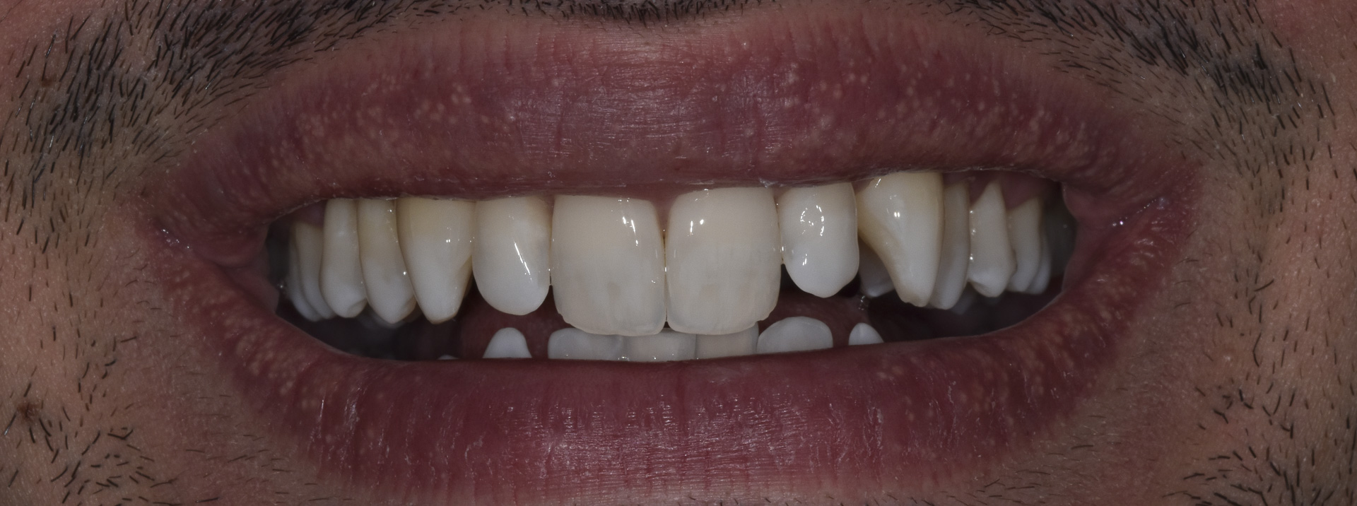 sbiancamento-denti-quarta-odontoiatria-studio-dentistico-carmiano-lecce-c4_1