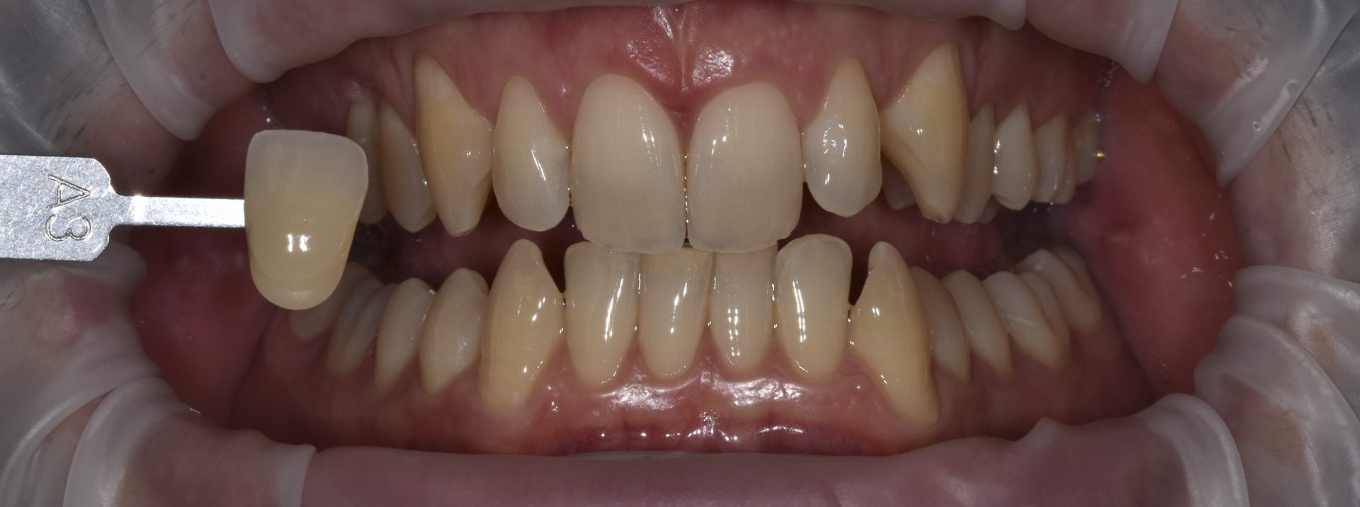 sbiancamento-denti-quarta-odontoiatria-studio-dentistico-carmiano-lecce-c4_2
