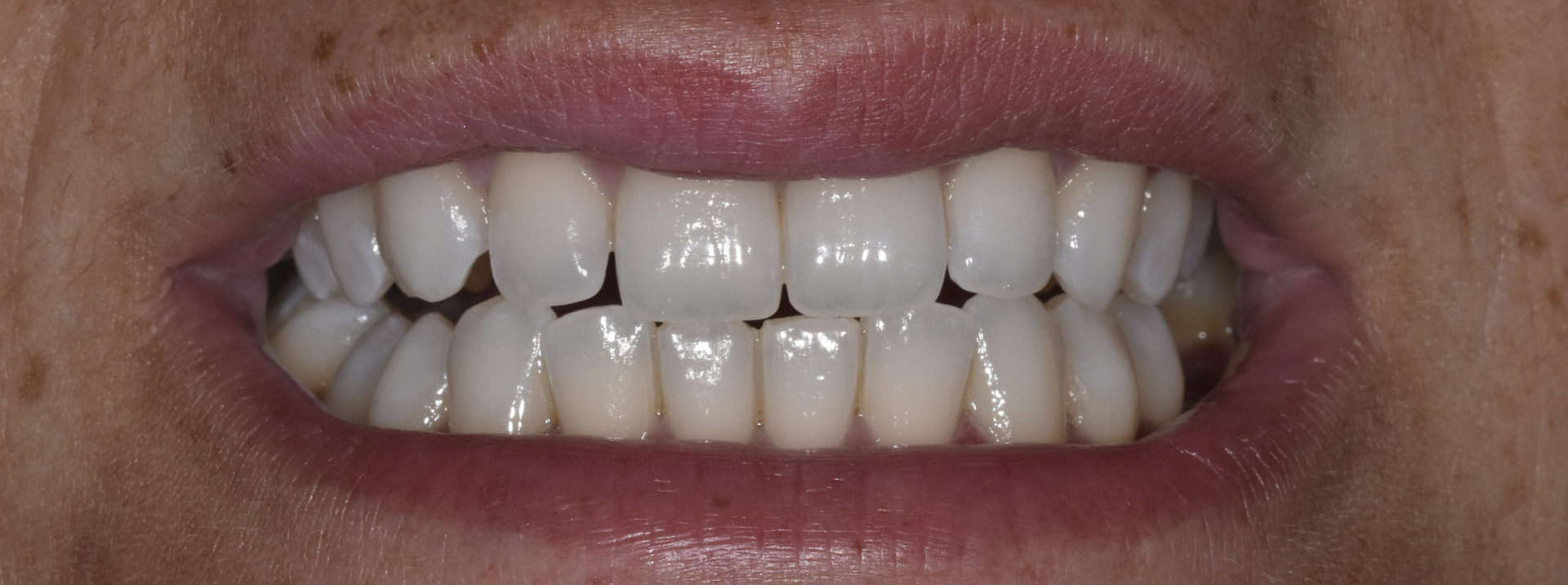 sbiancamento-denti-quarta-odontoiatria-studio-dentistico-carmiano-lecce-c5