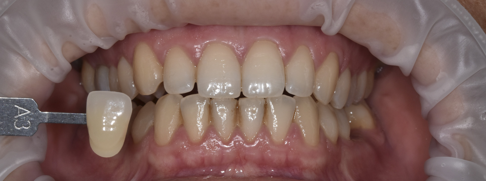 sbiancamento-denti-quarta-odontoiatria-studio-dentistico-carmiano-lecce-c5_1