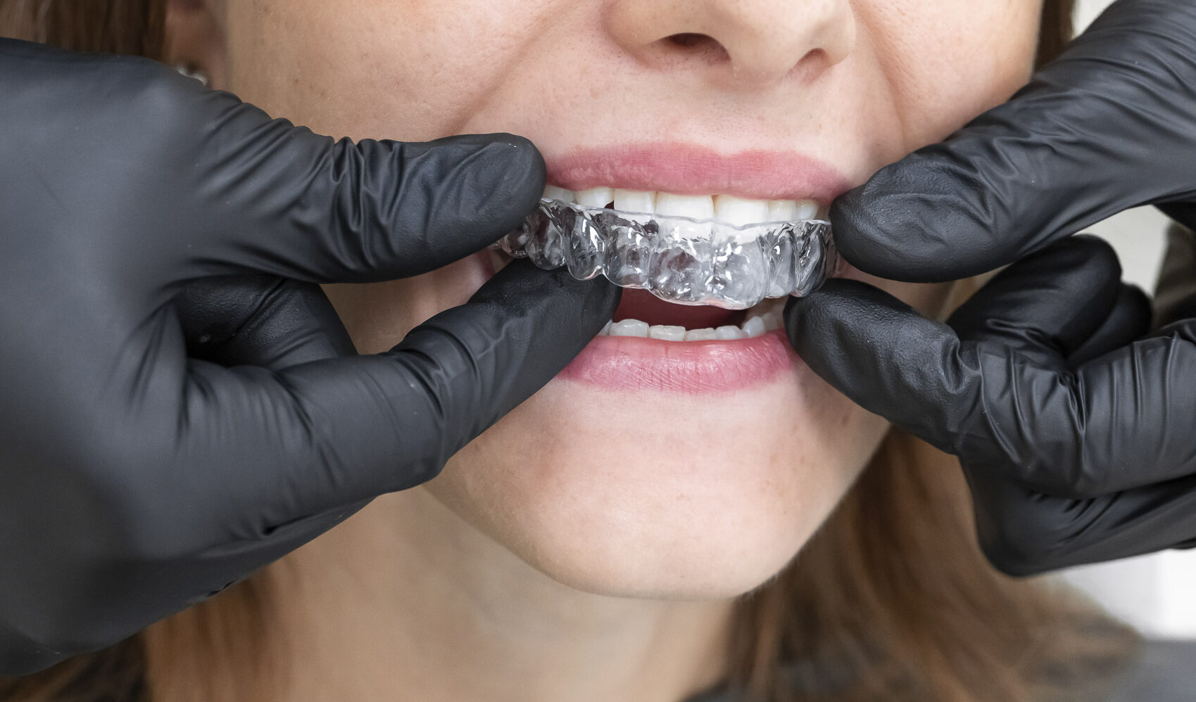 sbiancamento-denti-quarta-odontoiatria-studio-dentistico-carmiano-lecce_19