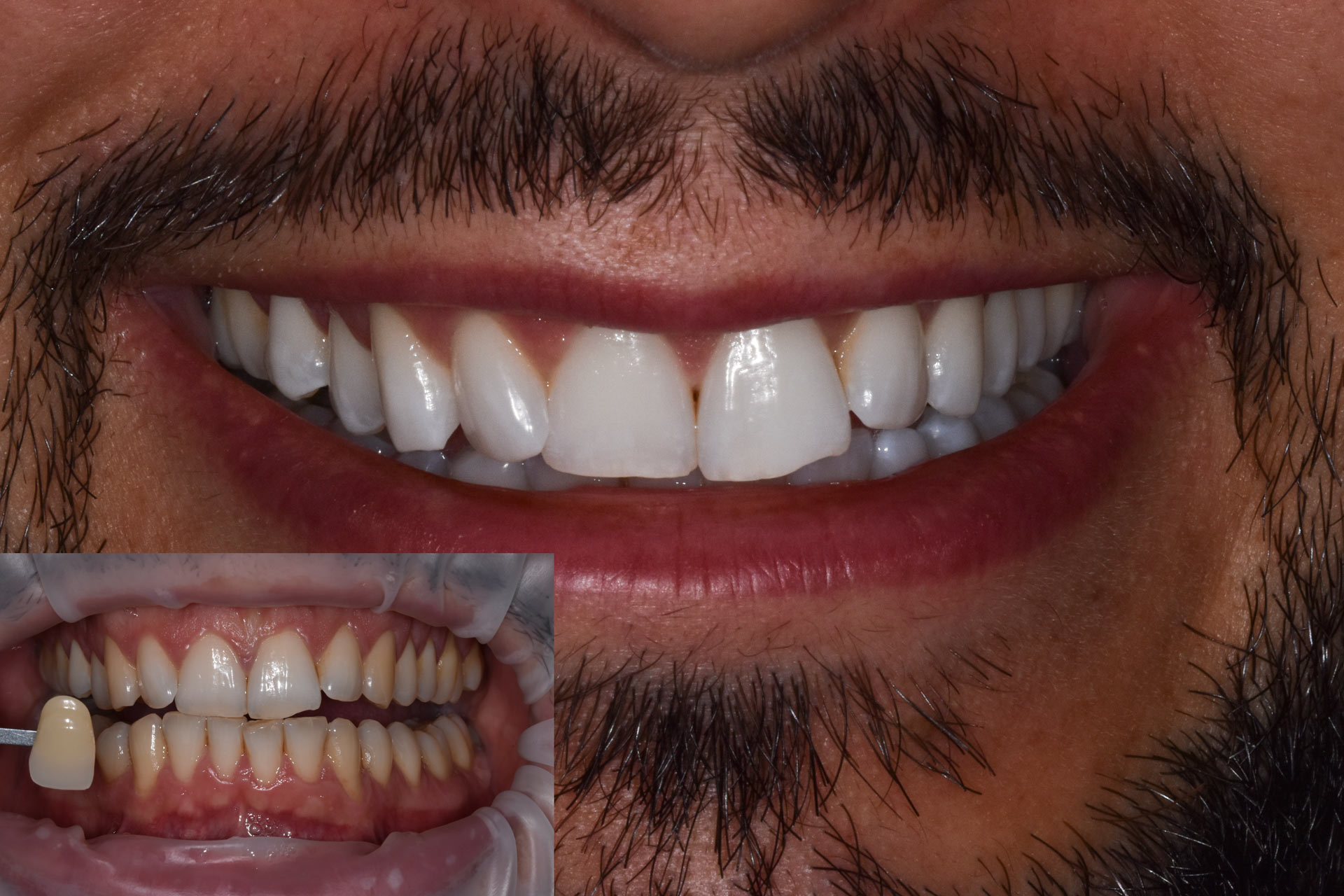sbiancamento-quarta-odontoiatria-studio-dentistico-lecce