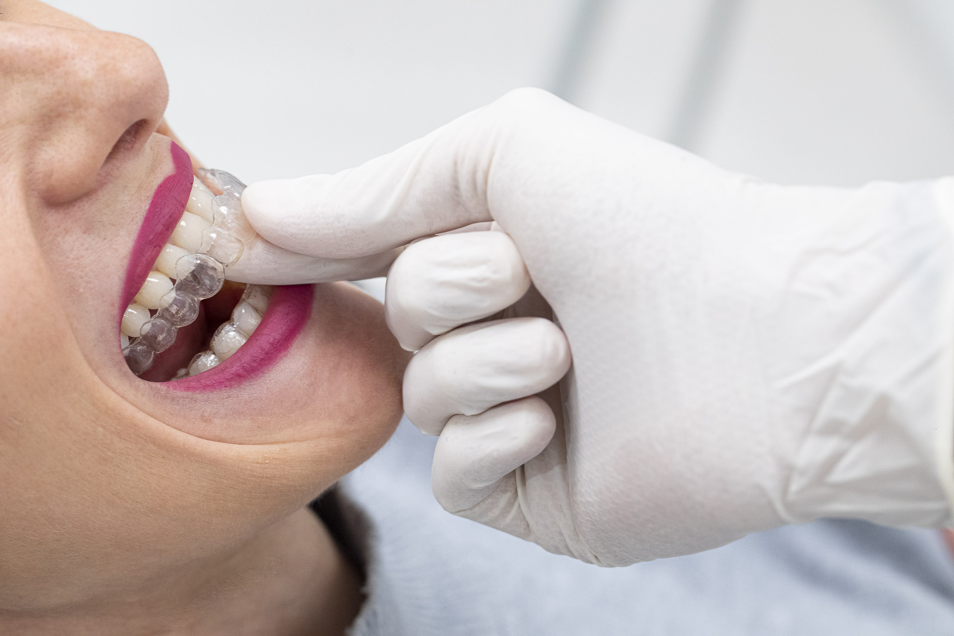 295A1919invisalign-quarta-odontoiatria-studio-dentistico-carmiano-lecce