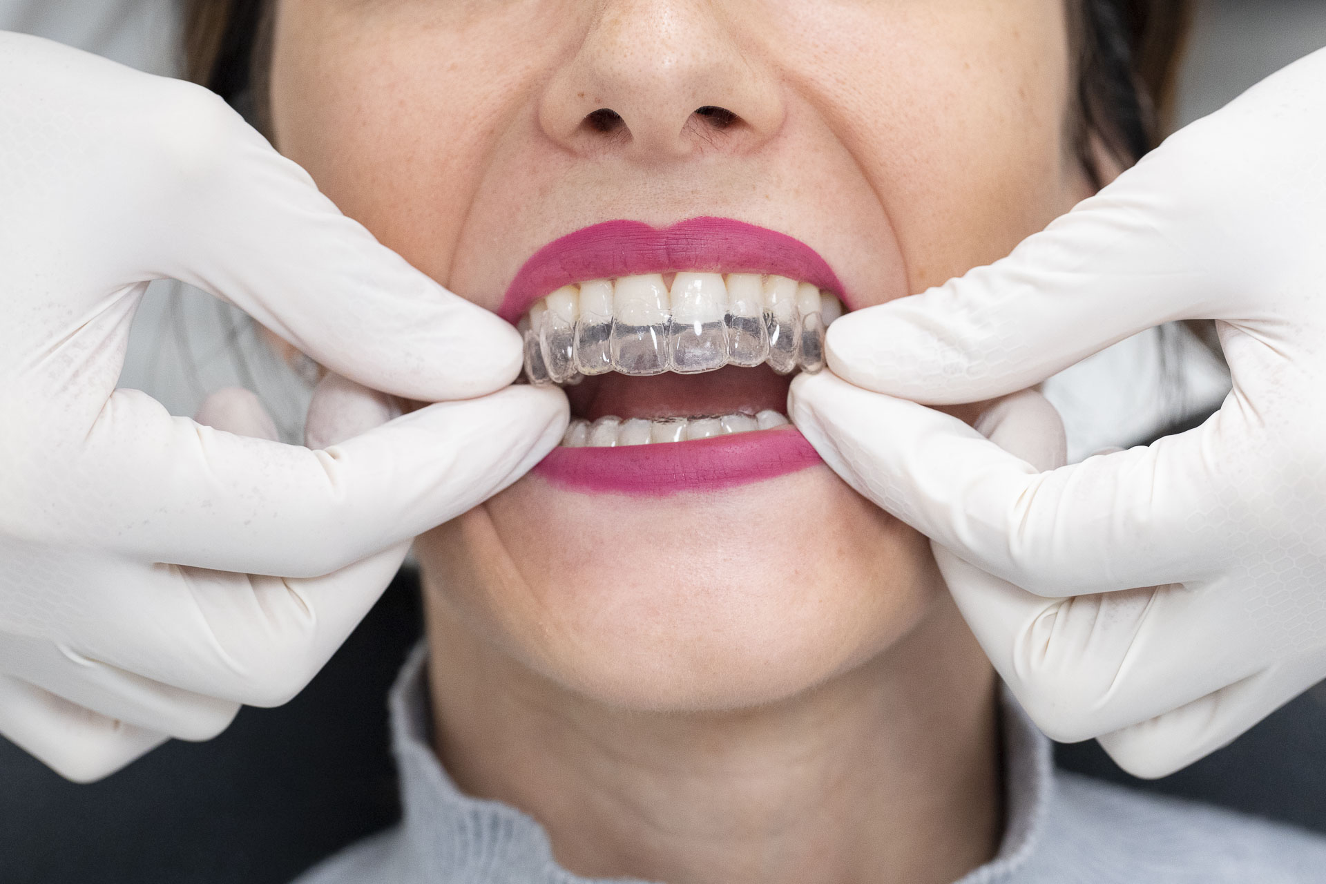 295A1938invisalign-quarta-odontoiatria-studio-dentistico-carmiano-lecce