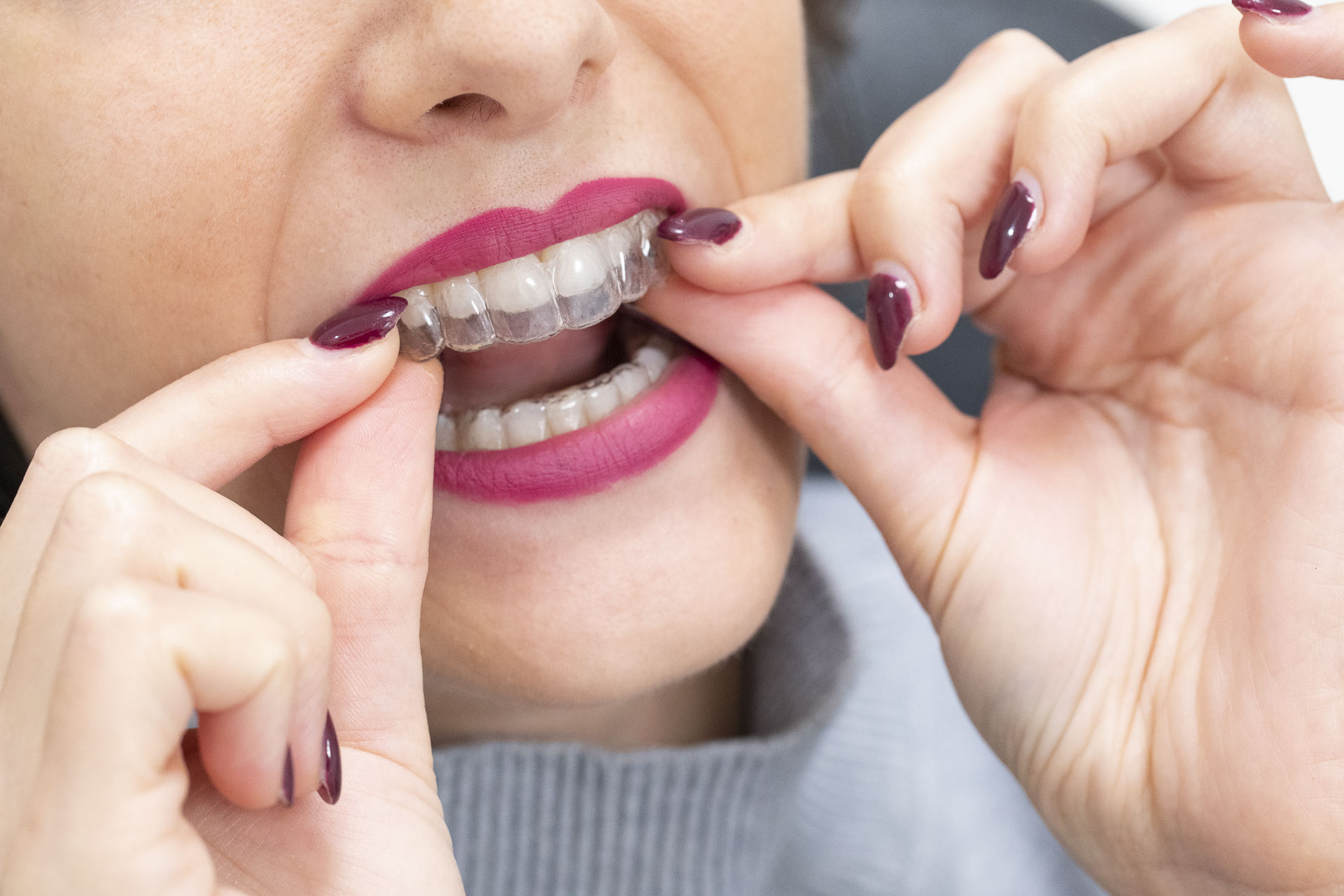 295A1951invisalign-quarta-odontoiatria-studio-dentistico-carmiano-lecce