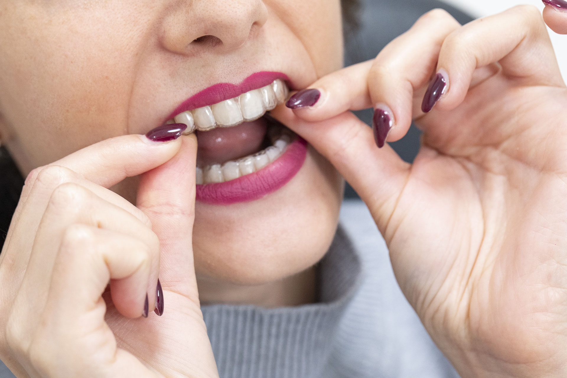 295A1958invisalign-quarta-odontoiatria-studio-dentistico-carmiano-lecce