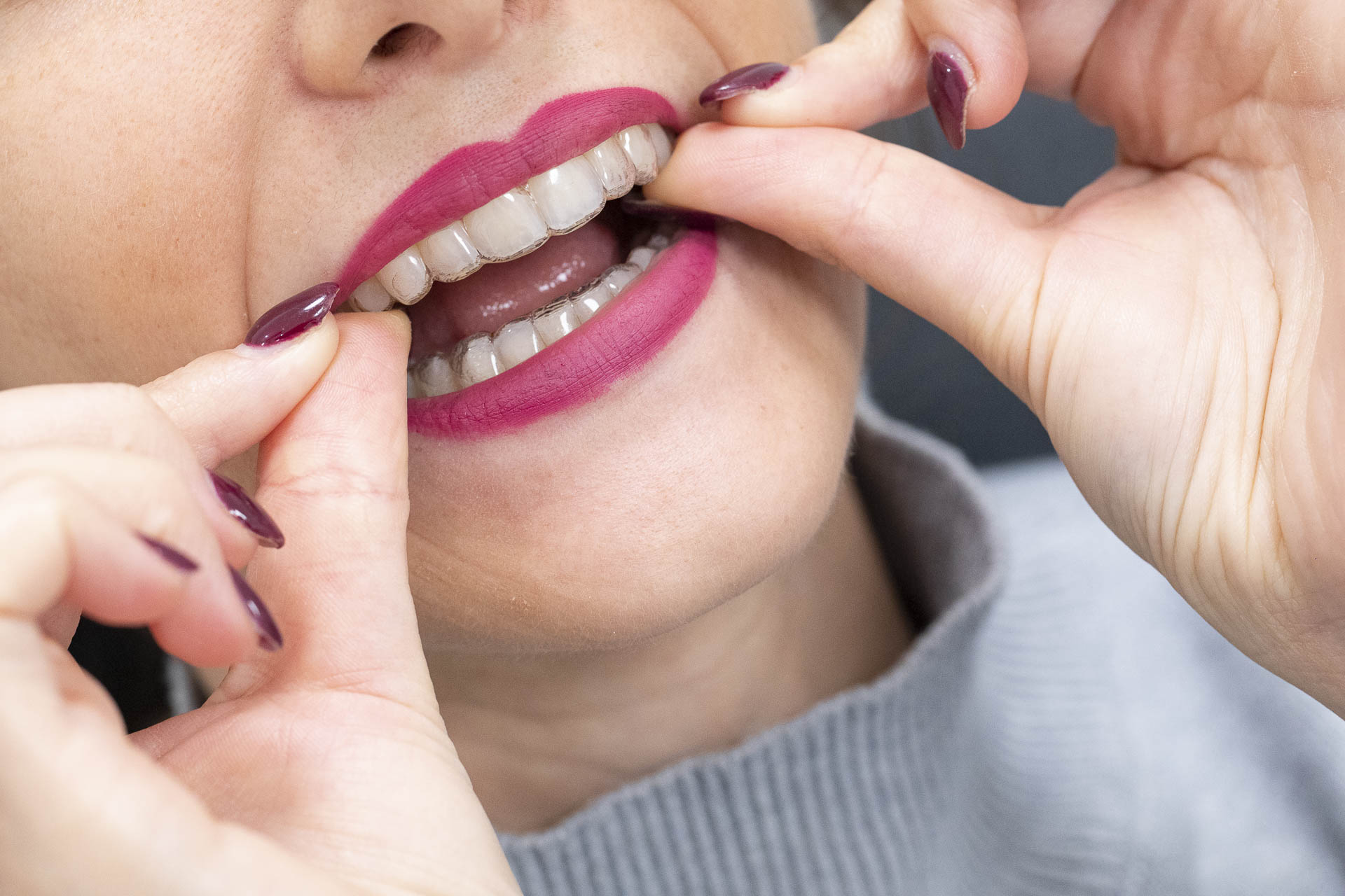 295A1964invisalign-quarta-odontoiatria-studio-dentistico-carmiano-lecce