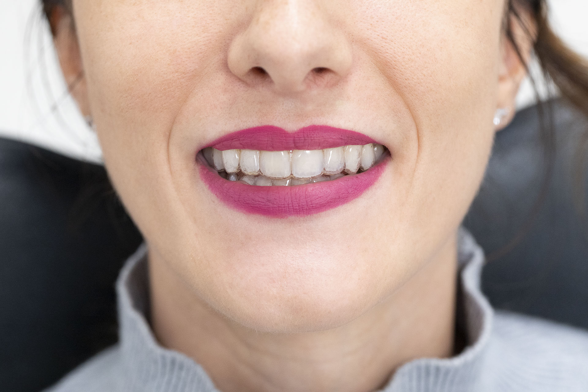 295A1974invisalign-quarta-odontoiatria-studio-dentistico-carmiano-lecce