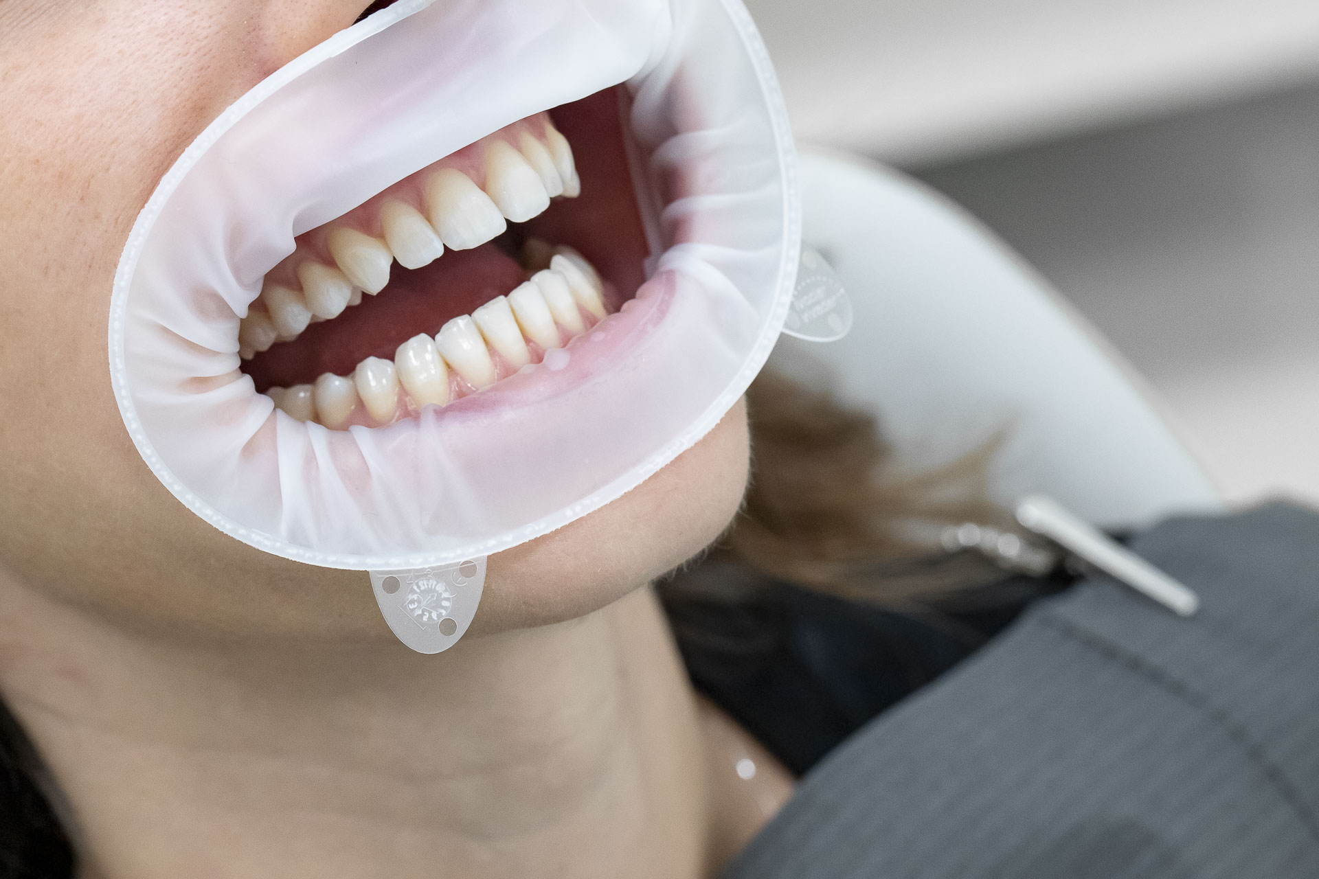 295A6430invisalign-quarta-odontoiatria-studio-dentistico-carmiano-lecce