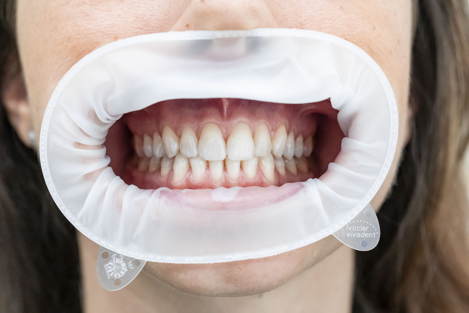 295A6459invisalign-quarta-odontoiatria-studio-dentistico-carmiano-lecce