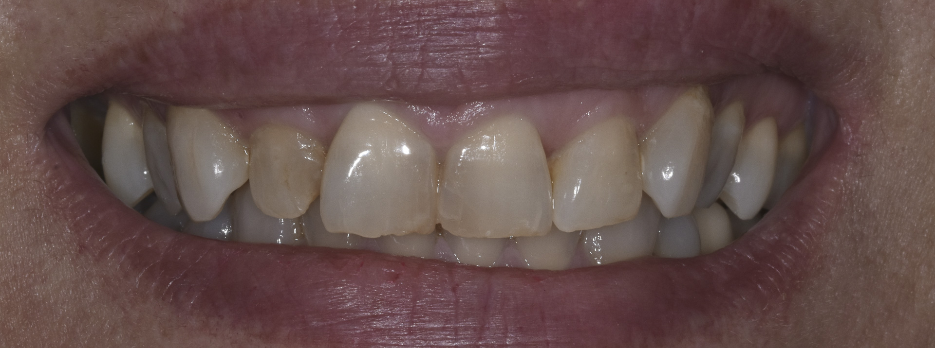 quarta-odontoiatria-studio-dentistico-carmiano-provincia-di-lecce-casi-clinici2-ricostruioni-estetiche-e-faccette-dentali-quarta-odontoiatria-studio-dentistico