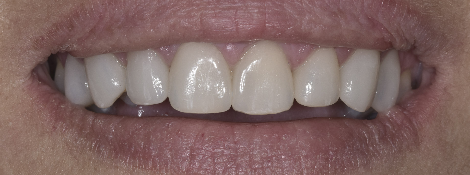 quarta-odontoiatria-studio-dentistico-carmiano-provincia-di-lecce-casi-clinici3-ricostruioni-estetiche-e-faccette-dentali-quarta-odontoiatria-studio-dentistico