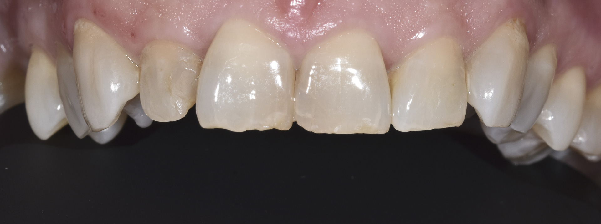 quarta-odontoiatria-studio-dentistico-carmiano-provincia-di-lecce-casi-clinici4-ricostruioni-estetiche-e-faccette-dentali-quarta-odontoiatria-studio-dentistico