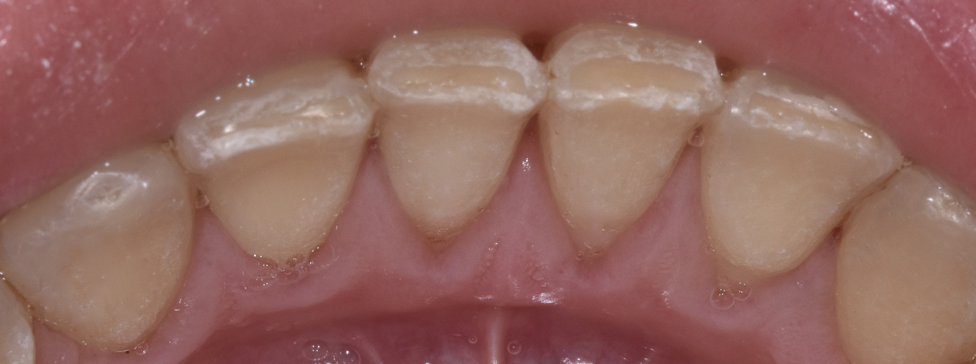 quarta-odontoiatria-studio-dentistico-carmiano-provincia-di-lecce-casi-clinici45quarta-odontoiatria-carmiano-lecce-studio-dentistico-prevenzione-odontostomatologica-e-igiene-orale