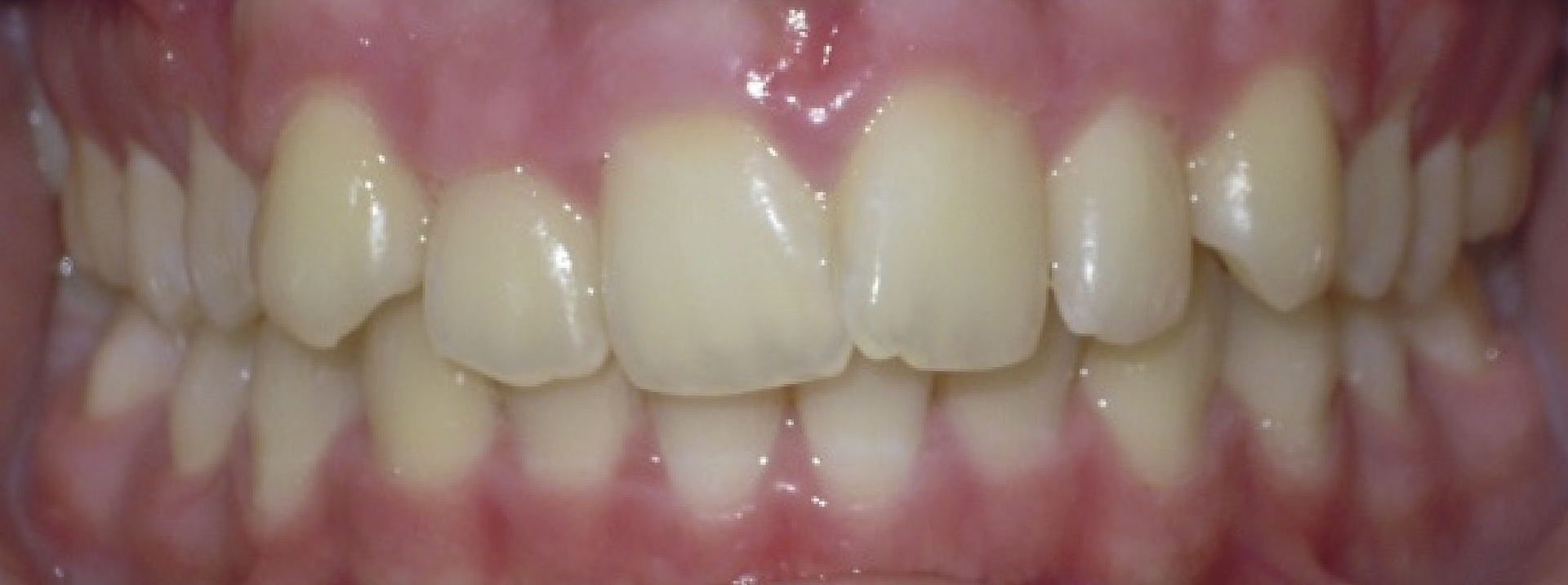 quarta-odontoiatria-studio-dentistico-carmiano-provincia-di-lecce-casi-clinici46invisalign-quarta-odontoiatria-studio-dentistico-carmiano-lecce