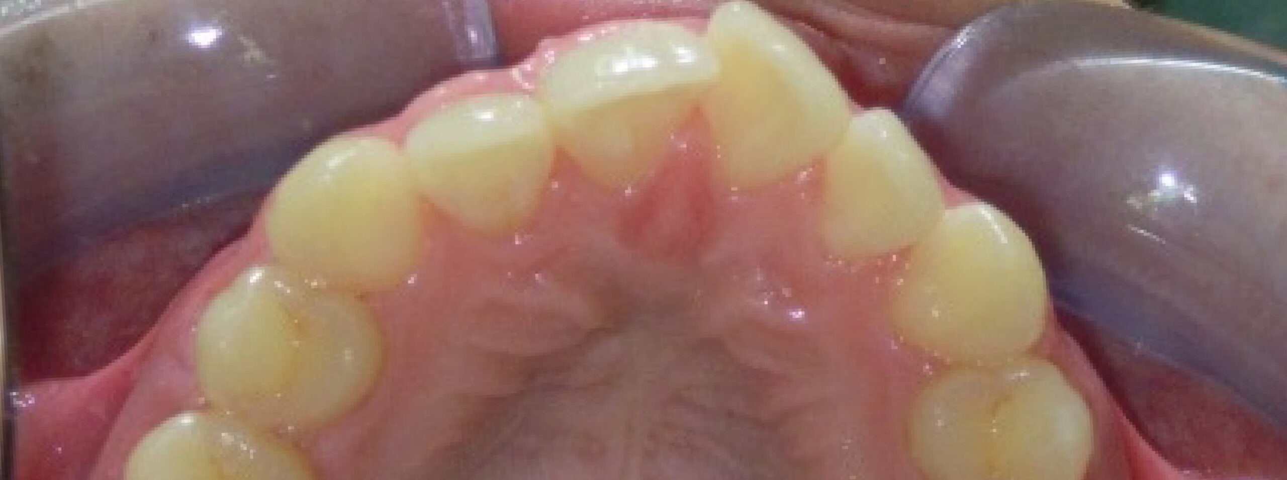quarta-odontoiatria-studio-dentistico-carmiano-provincia-di-lecce-casi-clinici48