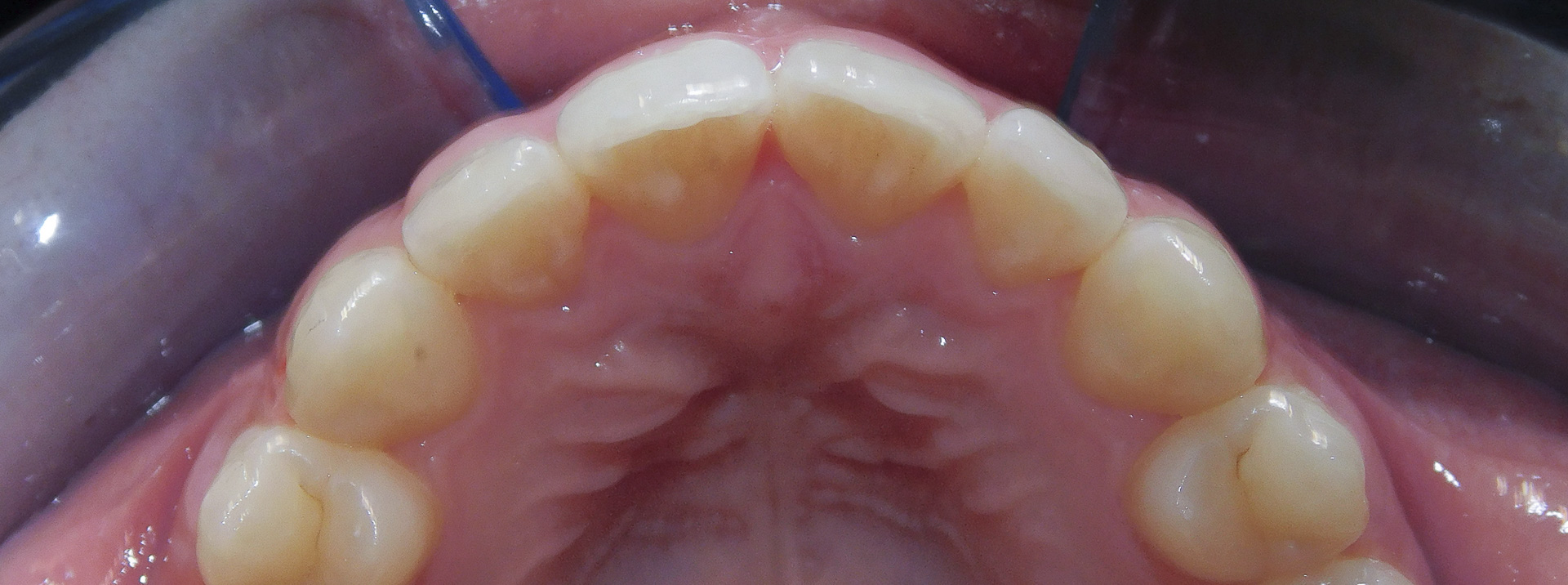quarta-odontoiatria-studio-dentistico-carmiano-provincia-di-lecce-casi-clinici49invisalign-quarta-odontoiatria-studio-dentistico-carmiano-lecce