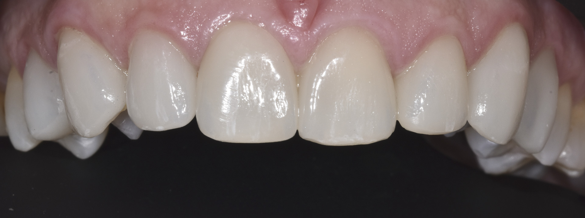 quarta-odontoiatria-studio-dentistico-carmiano-provincia-di-lecce-casi-clinici5-ricostruioni-estetiche-e-faccette-dentali-quarta-odontoiatria-studio-dentistico