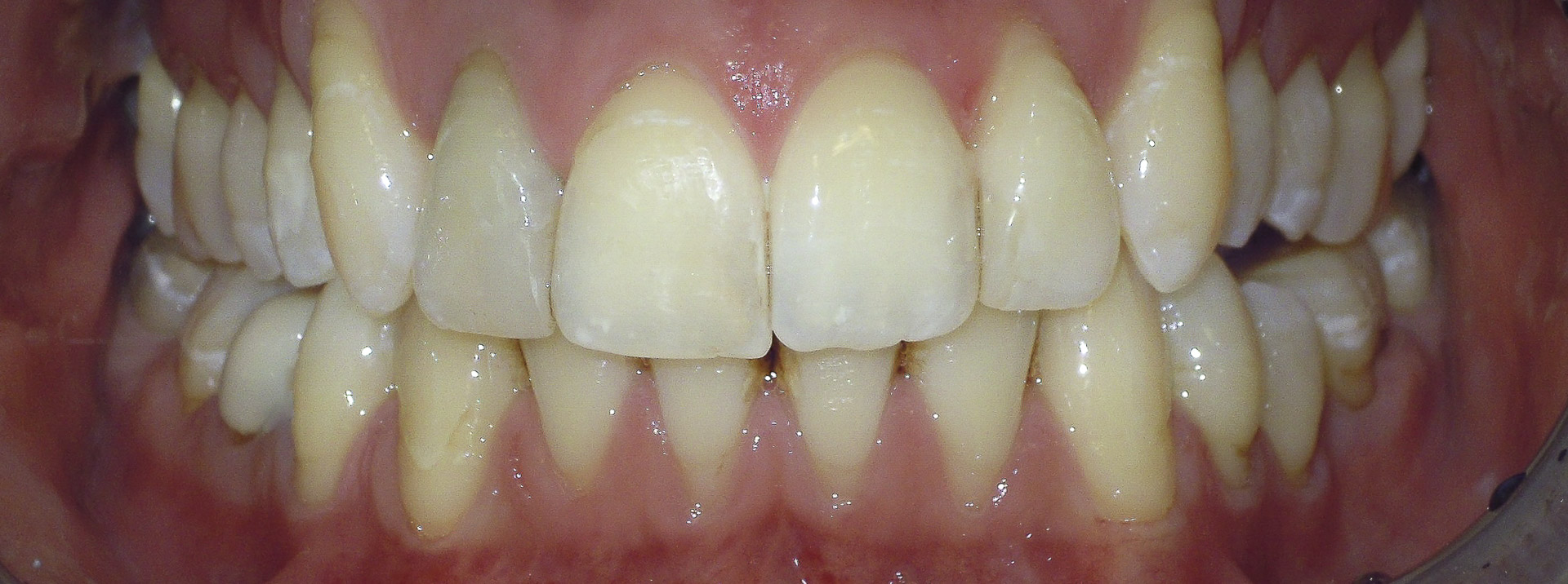 quarta-odontoiatria-studio-dentistico-carmiano-provincia-di-lecce-casi-clinici51invisalign-quarta-odontoiatria-studio-dentistico-carmiano-lecce