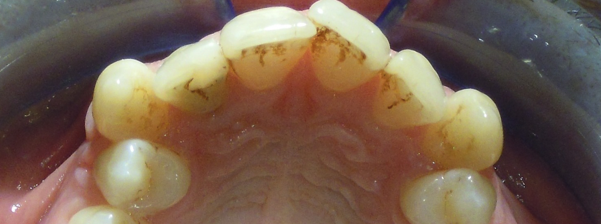 quarta-odontoiatria-studio-dentistico-carmiano-provincia-di-lecce-casi-clinici52invisalign-quarta-odontoiatria-studio-dentistico-carmiano-lecce