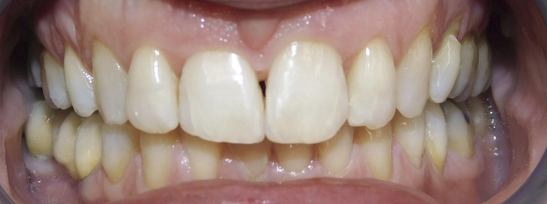 quarta-odontoiatria-studio-dentistico-carmiano-provincia-di-lecce-casi-clinici57invisalign-quarta-odontoiatria-studio-dentistico-carmiano-lecce