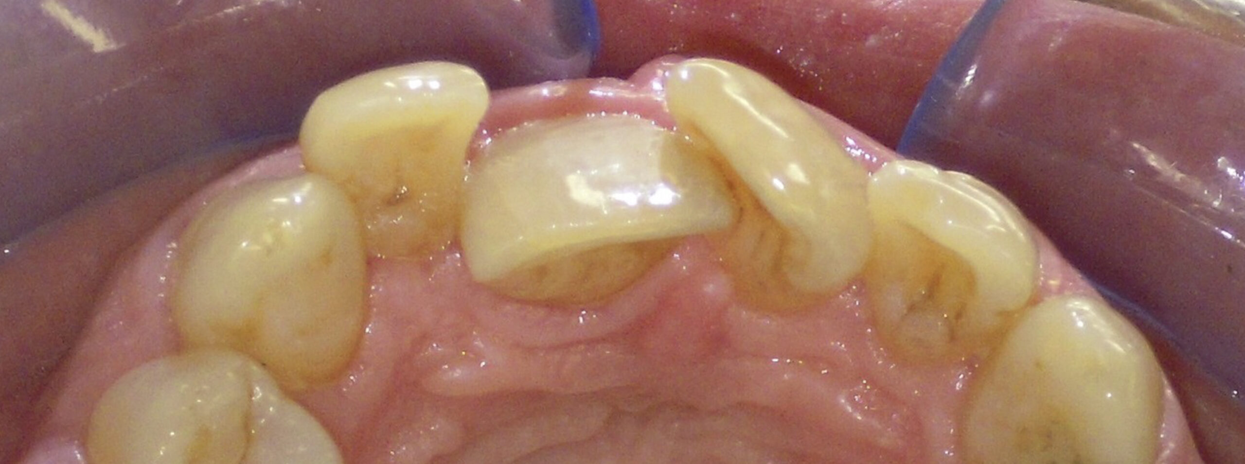 quarta-odontoiatria-studio-dentistico-carmiano-provincia-di-lecce-casi-clinici58