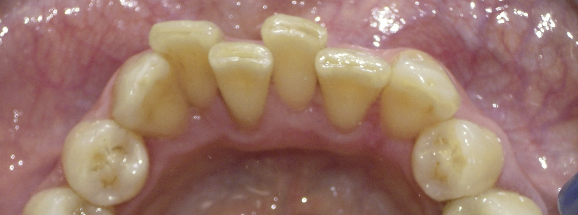 quarta-odontoiatria-studio-dentistico-carmiano-provincia-di-lecce-casi-clinici60invisalign-quarta-odontoiatria-studio-dentistico-carmiano-lecce
