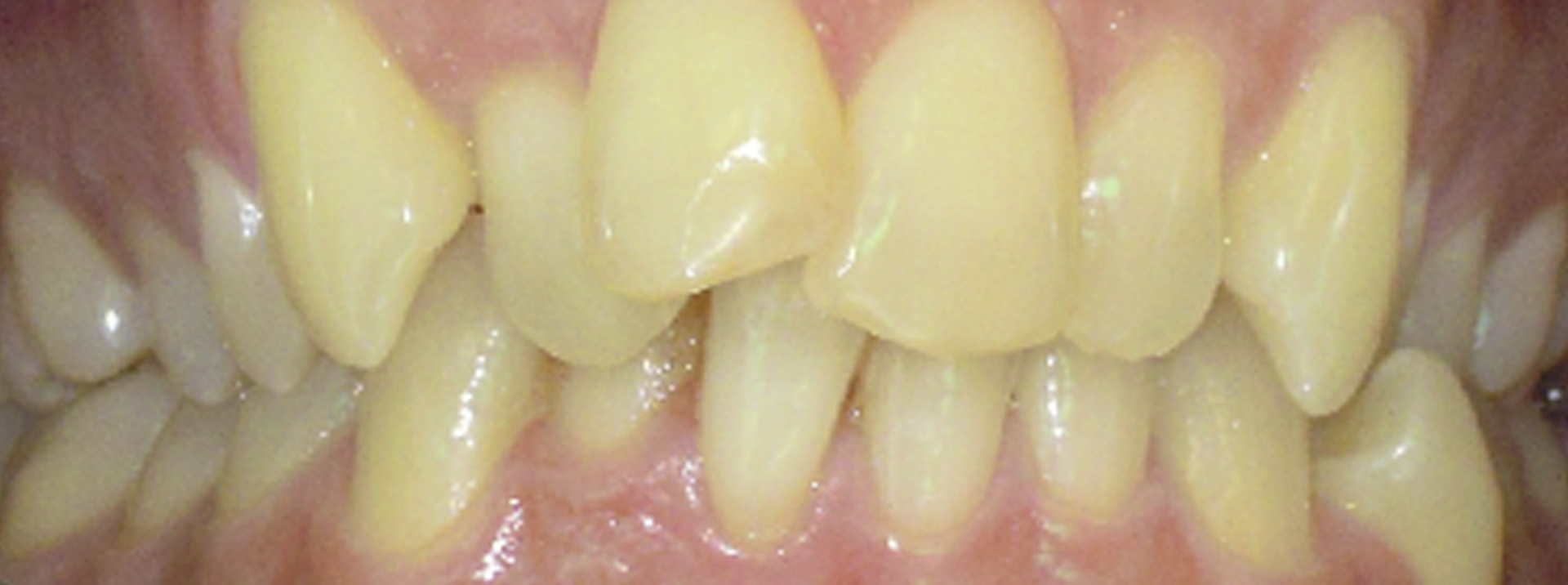 quarta-odontoiatria-studio-dentistico-carmiano-provincia-di-lecce-casi-clinici64invisalign-quarta-odontoiatria-studio-dentistico-carmiano-lecce
