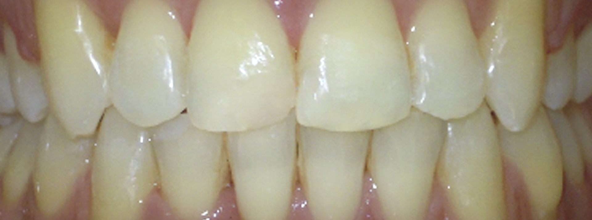 quarta-odontoiatria-studio-dentistico-carmiano-provincia-di-lecce-casi-clinici65invisalign-quarta-odontoiatria-studio-dentistico-carmiano-lecce