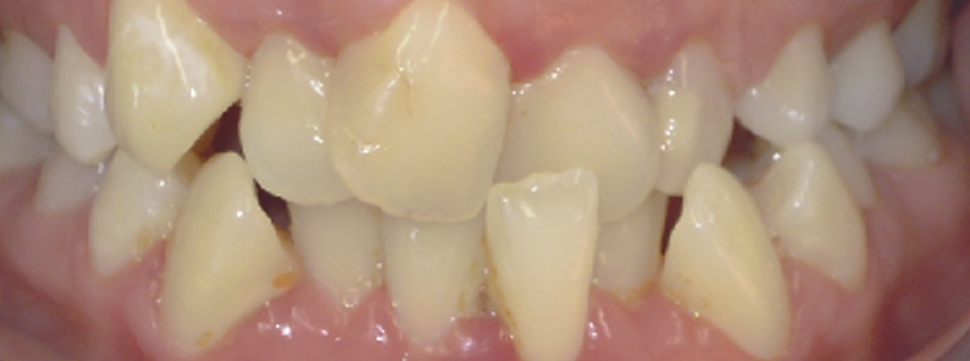 quarta-odontoiatria-studio-dentistico-carmiano-provincia-di-lecce-casi-clinici66invisalign-quarta-odontoiatria-studio-dentistico-carmiano-lecce