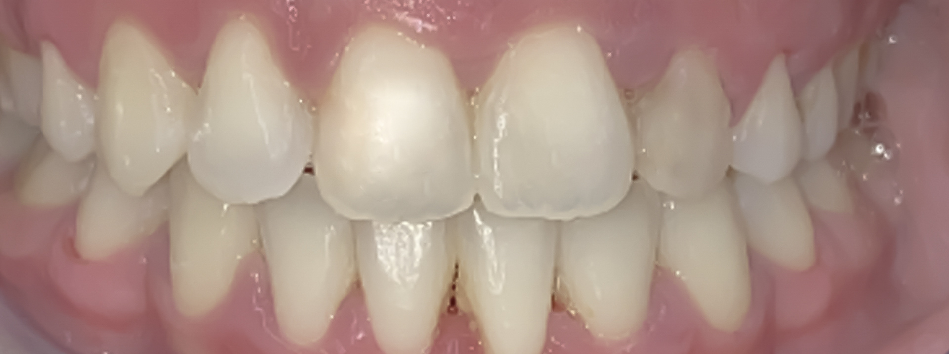 quarta-odontoiatria-studio-dentistico-carmiano-provincia-di-lecce-casi-clinici67invisalign-quarta-odontoiatria-studio-dentistico-carmiano-lecce