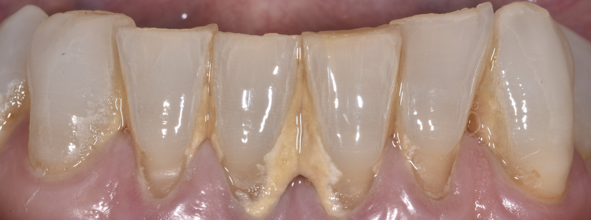 quarta-odontoiatria-studio-dentistico-carmiano-provincia-di-lecce-casi-clinici86quarta-odontoiatria-carmiano-lecce-studio-dentistico-prevenzione-odontostomatologica-e-igiene-orale