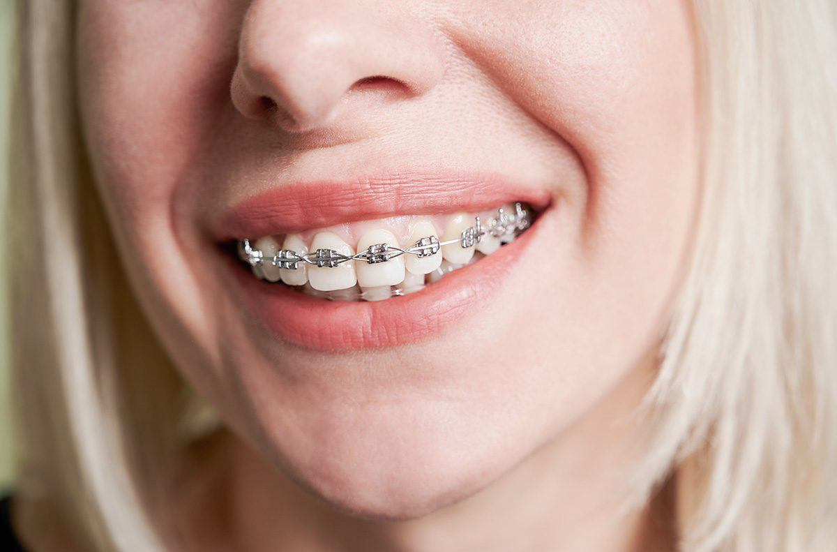 3-quarta-odontoiatria-apparecchio-denti-per-adulti-e-bambini
