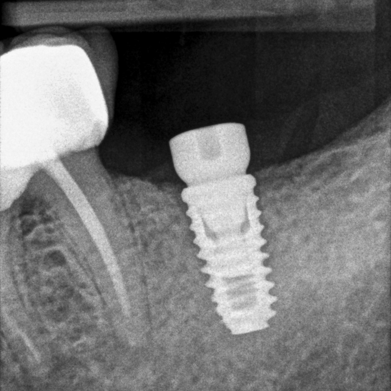 Attanasio_Alessandro_20220718_135643quarta-odontoiatria-studio-dentistico-carmiano-odontoiatria-digitaleimplantologia-quarta-odontoiatria-studio-dentistico-carmiano-lecce
