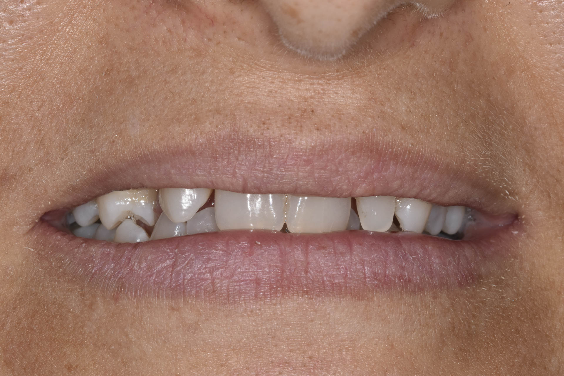DSC_0245implantologia-quarta-odontoiatria-studio-dentistico-carmiano-lecce