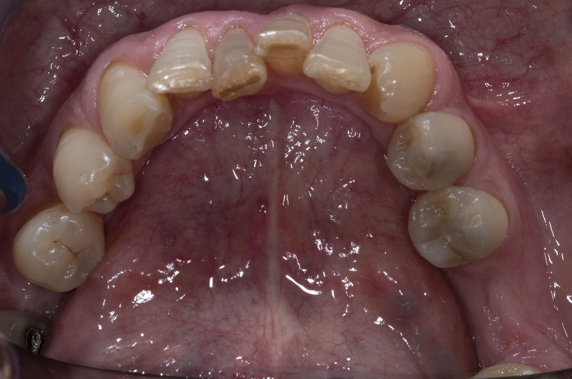 DSC_0676modificataimplantologia-quarta-odontoiatria-studio-dentistico-carmiano-lecce