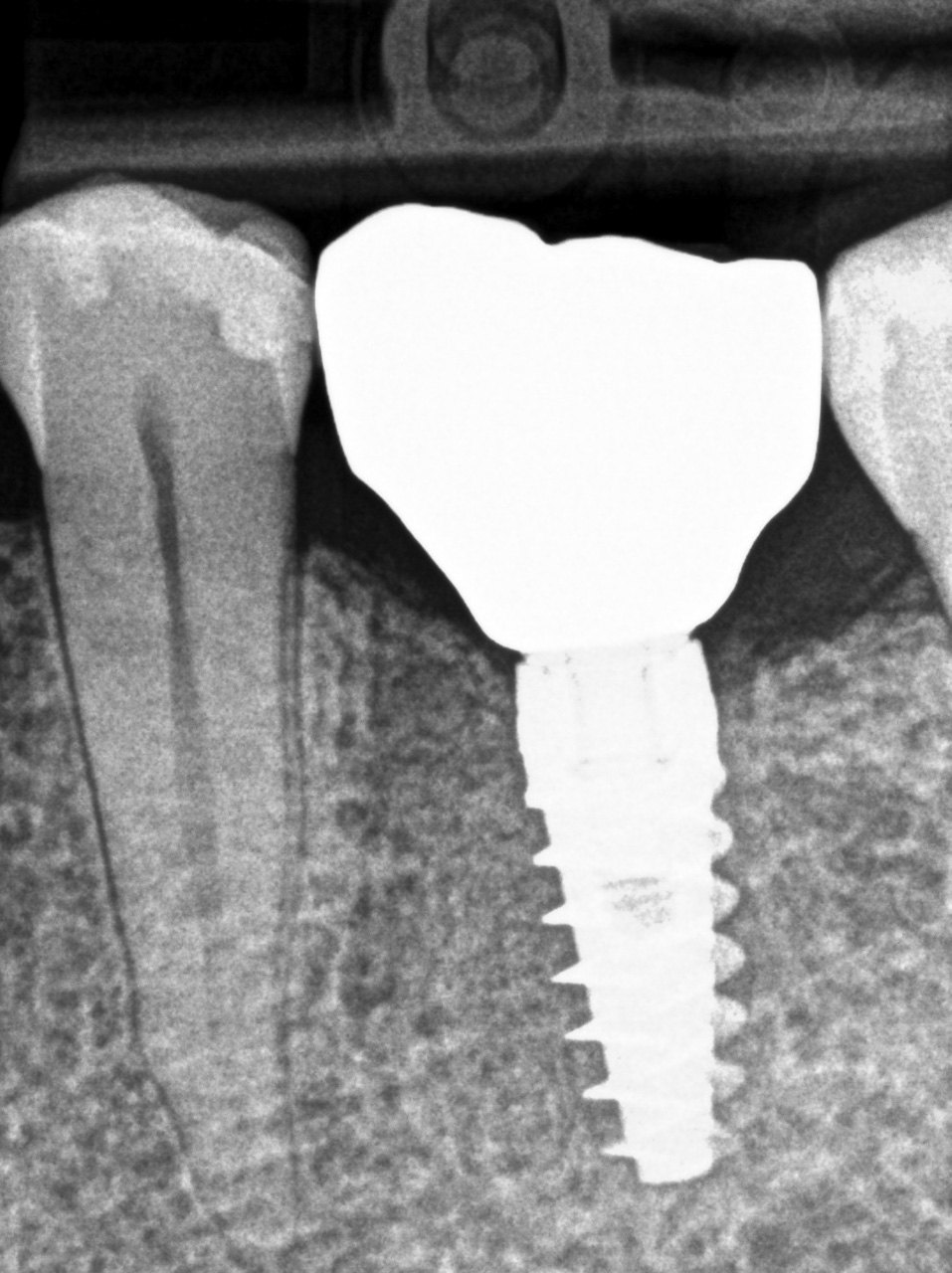 Lotito_Giusy_20220328_091018implantologia-quarta-odontoiatria-studio-dentistico-carmiano-lecce