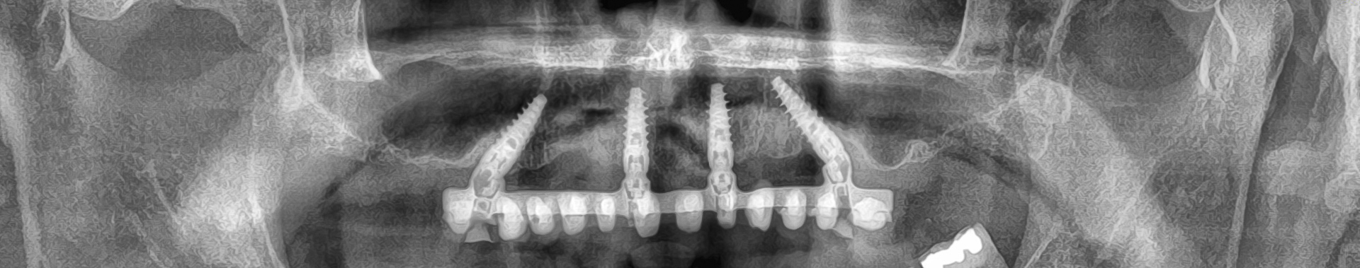 Pagliara_Luigi_20221212_102300implantologia-quarta-odontoiatria-studio-dentistico-carmiano-lecce