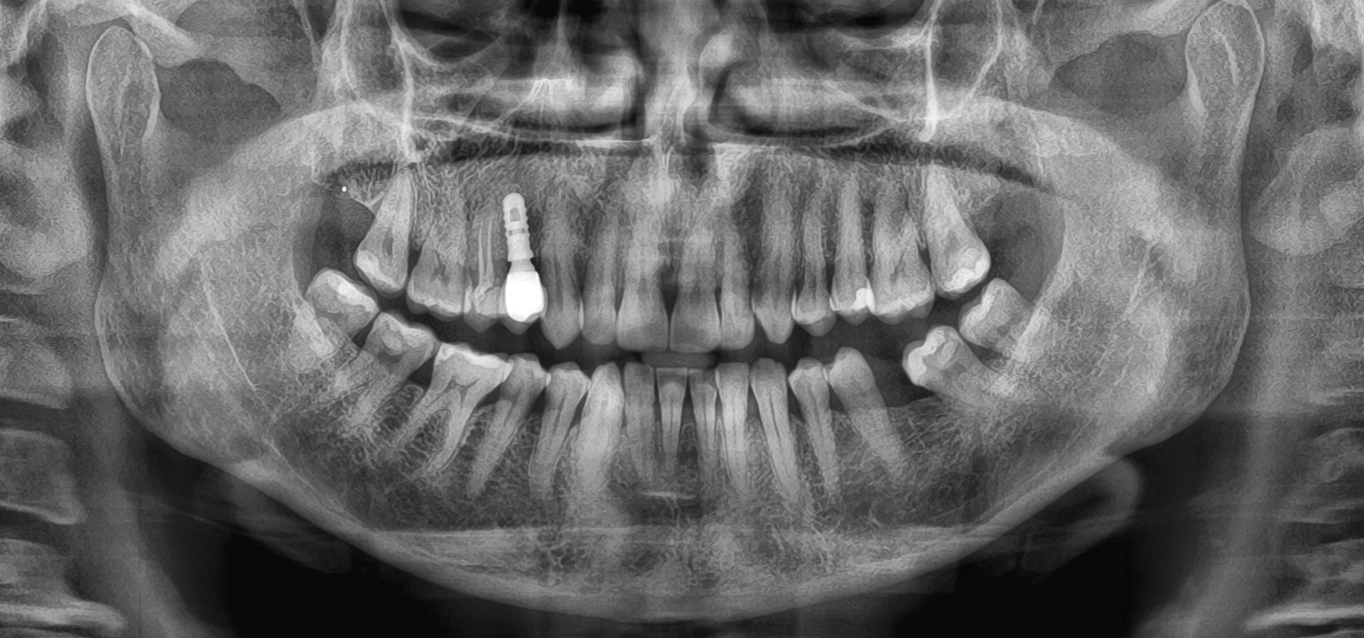 Puscio_Onorina_20221130_191253implantologia-quarta-odontoiatria-studio-dentistico-carmiano-lecce