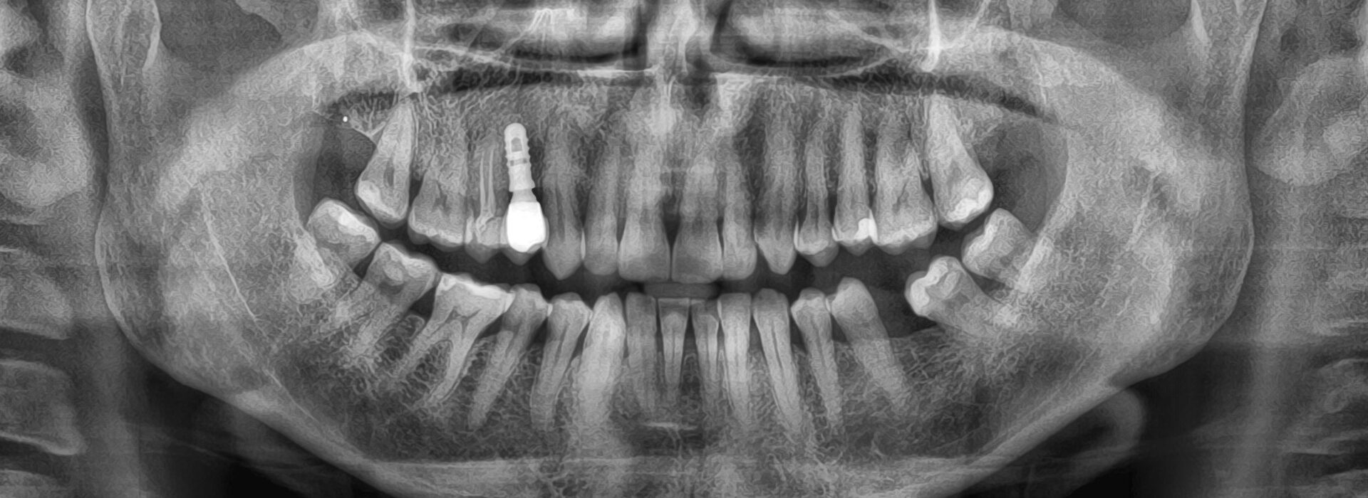 Puscio_Onorina_20221130_191253implantologia-quarta-odontoiatria-studio-dentistico-carmiano-lecce