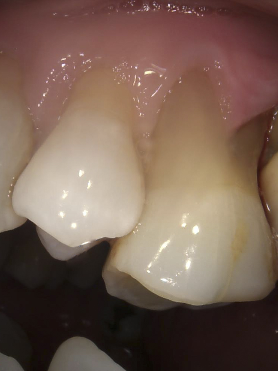 Solinas_Filomena_20220822_174229implantologia-quarta-odontoiatria-studio-dentistico-carmiano-lecce