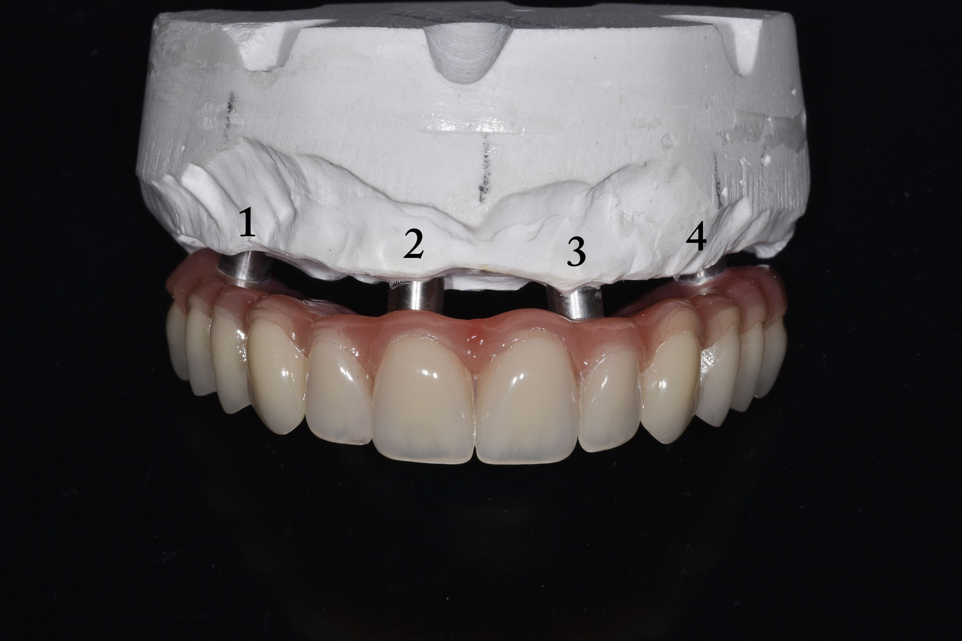 impianto-DSC_0705implantologia-quarta-odontoiatria-studio-dentistico-carmiano-lecce-1