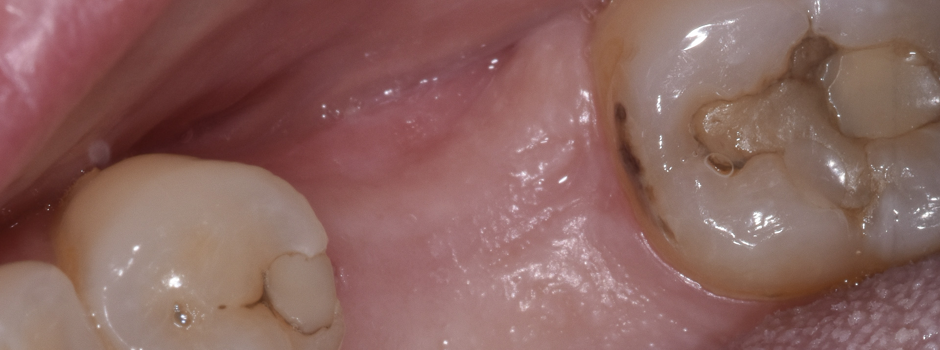 quarta-odontoiatria-studio-dentistico-carmiano-provincia-di-lecce-casi-clinici70implantologia-quarta-odontoiatria-studio-dentistico-carmiano-lecce
