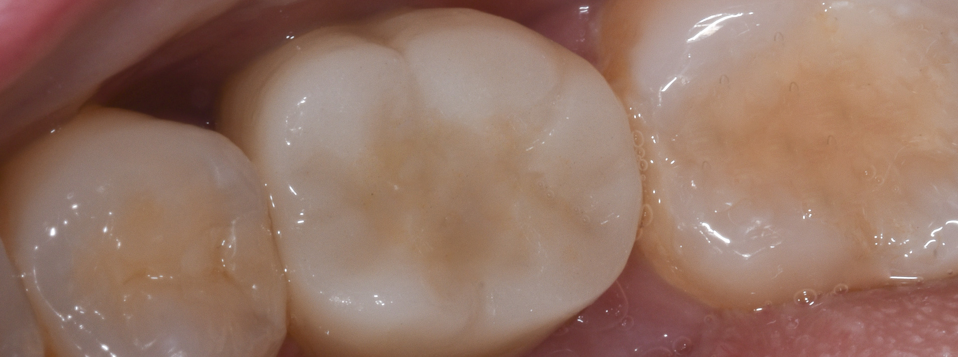 quarta-odontoiatria-studio-dentistico-carmiano-provincia-di-lecce-casi-clinici71implantologia-quarta-odontoiatria-studio-dentistico-carmiano-lecce
