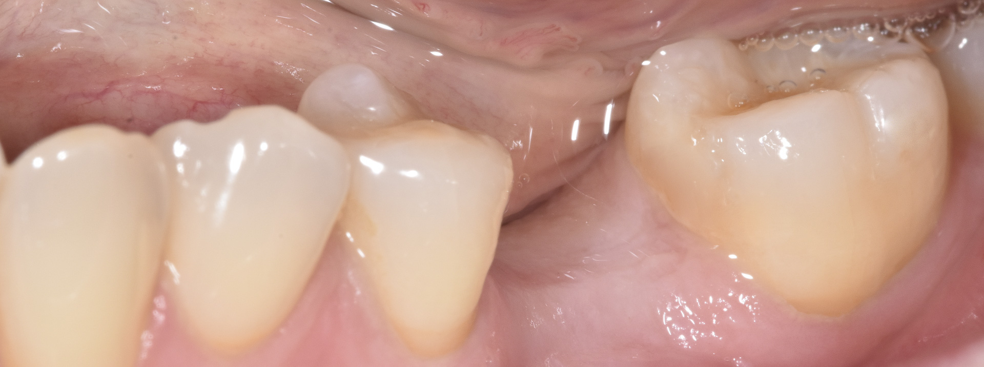 quarta-odontoiatria-studio-dentistico-carmiano-provincia-di-lecce-casi-clinici72implantologia-quarta-odontoiatria-studio-dentistico-carmiano-lecce